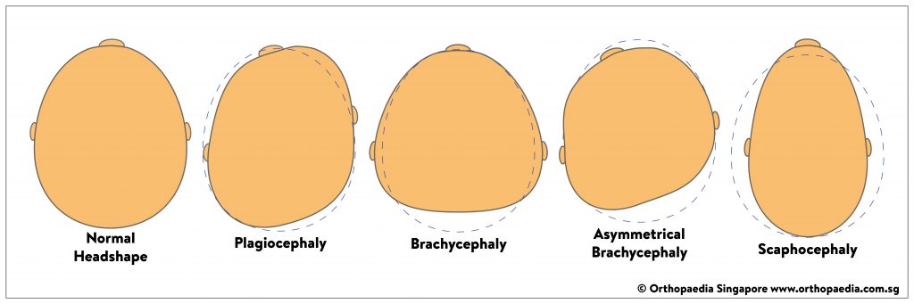 Does Your Baby Have Flat Head Syndrome? - Orthopaedia